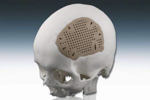 EOS Implant